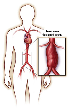 Лечение аневризмы грудной аорты