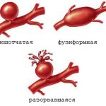 Лечение аневризмы головного мозга в Израиле