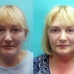 Пластика век в Израиле: результат