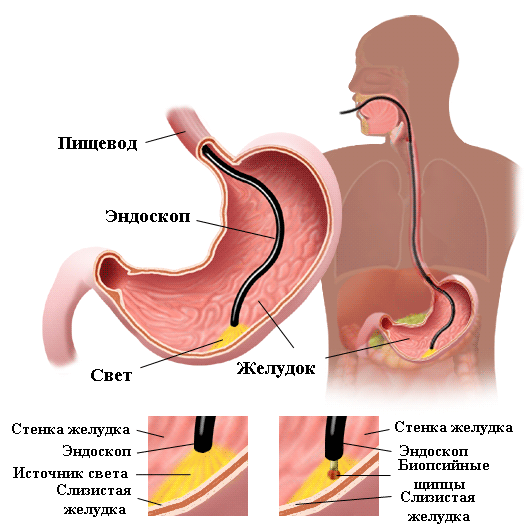 Гастроскопия в Израиле