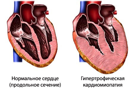 Лечение гипертрофической кардиомиопатии