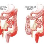 Лечение болезни Крона в Израиле