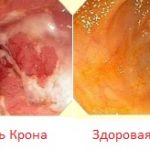 Лечение болезни Крона в Израиле
