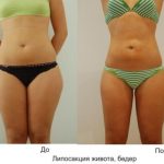 Липосакция в Израиле: результат