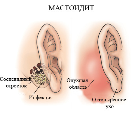 Лечение мастоидита в Израиле