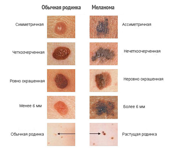 Лечение меланомы в Израиле