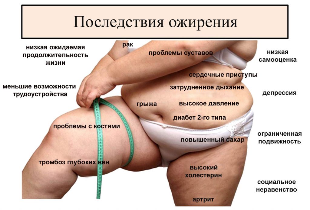 Лечение ожирения в Израиле