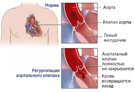 Лечение порока сердца в Израиле