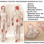 Лечение псориаза в Израиле