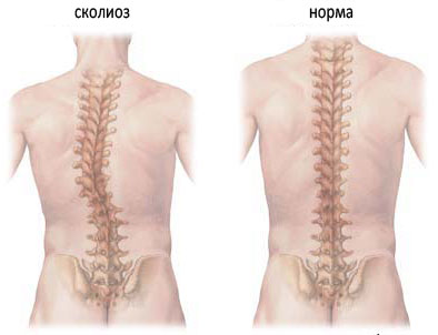 Лечение сколиоза в Израиле