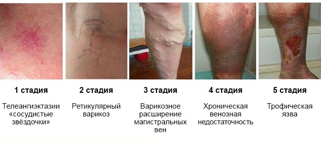 Варикоз