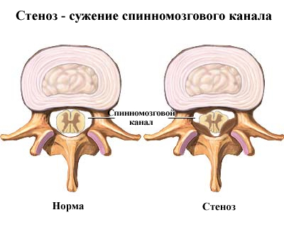 Лечение стеноза позвоночного канала в Израиле