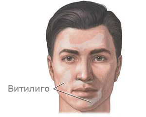 Лечение витилиго в Израиле