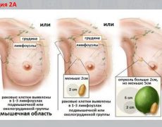 Лечение рака молочной железы II стадии