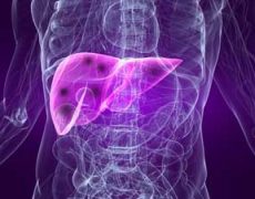 SIRT-терапия: инновационный метод лечения рака печени в Израиле