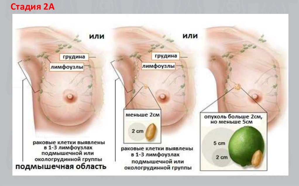 Лечение рака молочной железы II стадии