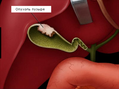 Рак желчного пузыря: проявление