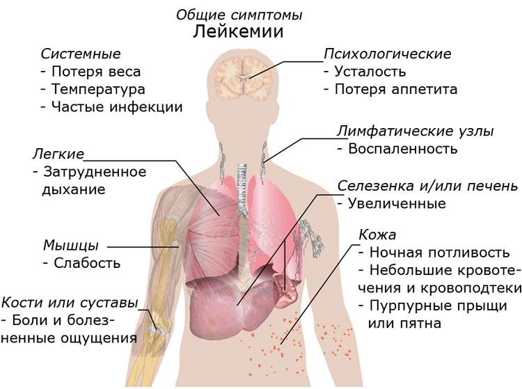 Лечение лейкемии в Израиле