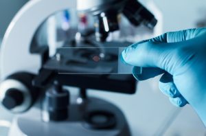 Расшифровка анализа на онкомаркеры 